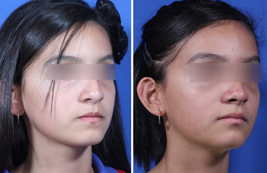Rhinoplasty Before and After Patient 3
