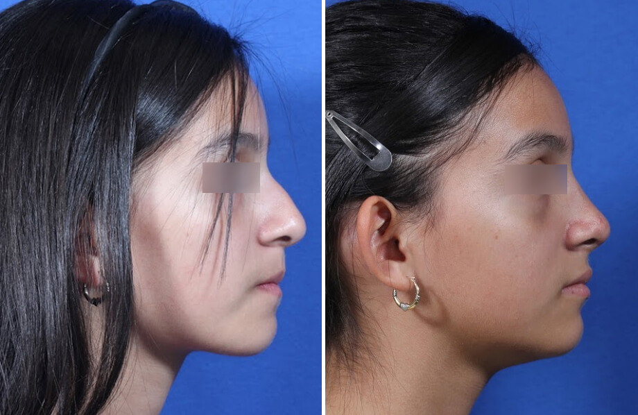 Rhinoplasty Before and After Patient 1