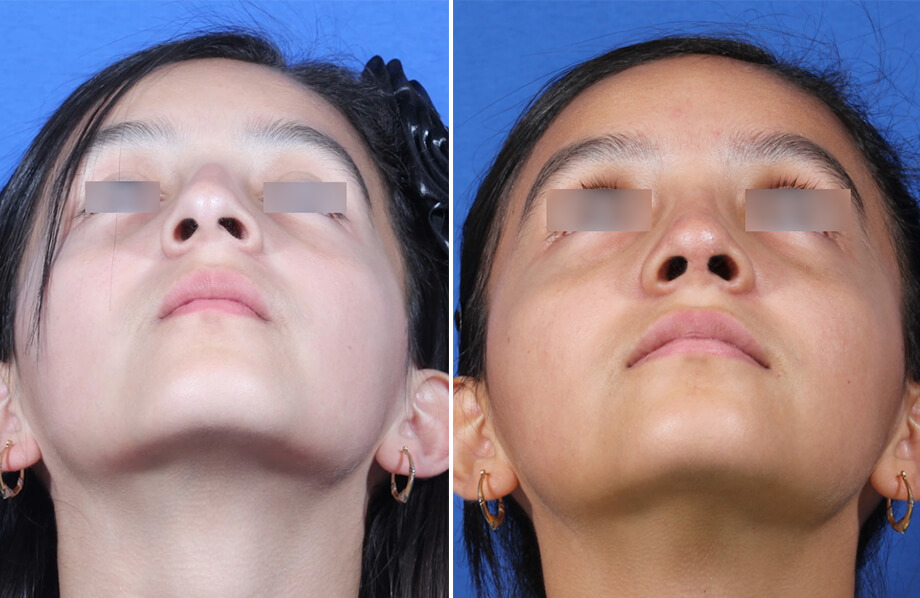Rhinoplasty Before and After Patient 4