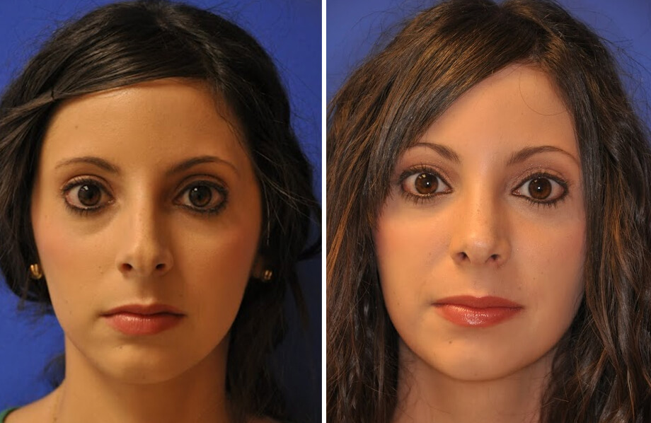 Rhinoplasty Before and After Patient 2