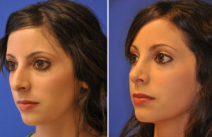 Rhinoplasty Before and After Patient Thumbnail 3