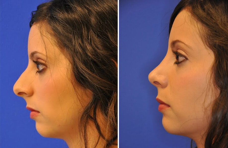 Rhinoplasty Before and After Patient 1