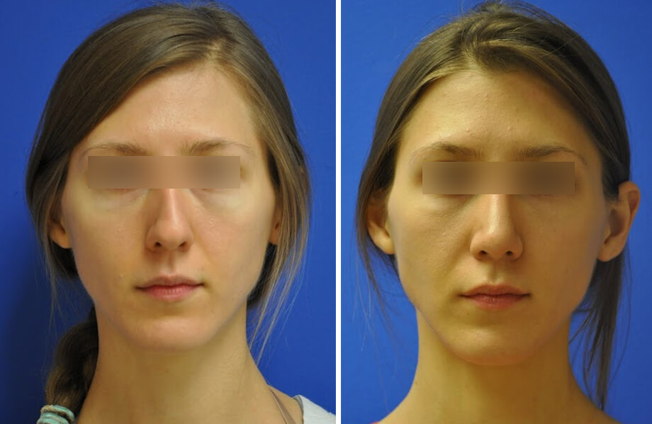Rhinoplasty Before and After Patient 2