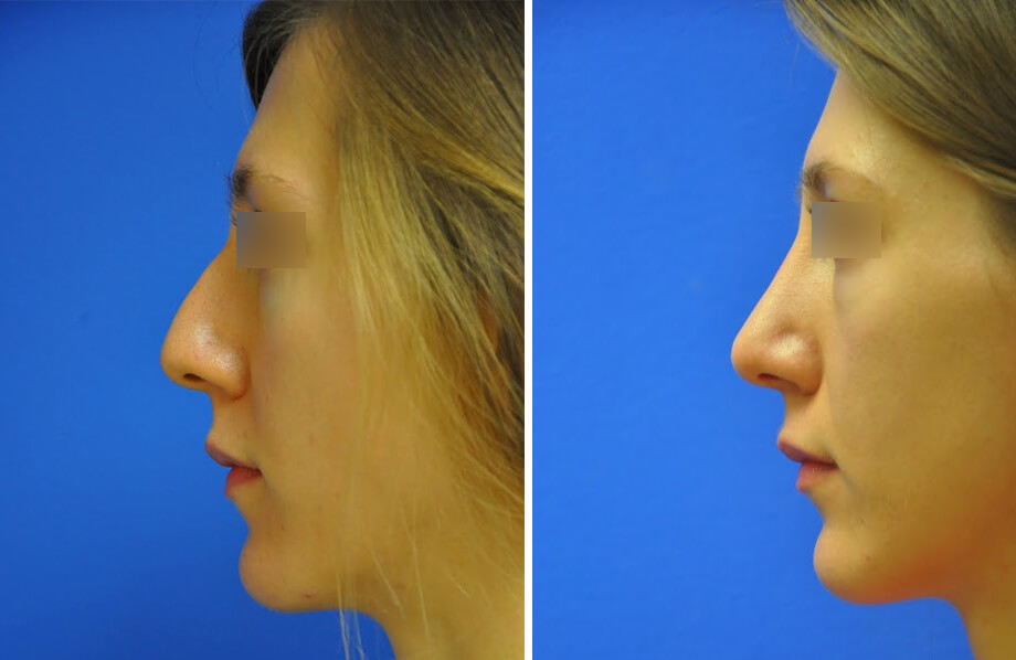 Rhinoplasty Before and After Patient 1