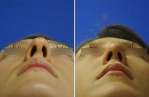 Rhinoplasty Before and After Patient Thumbnail 4