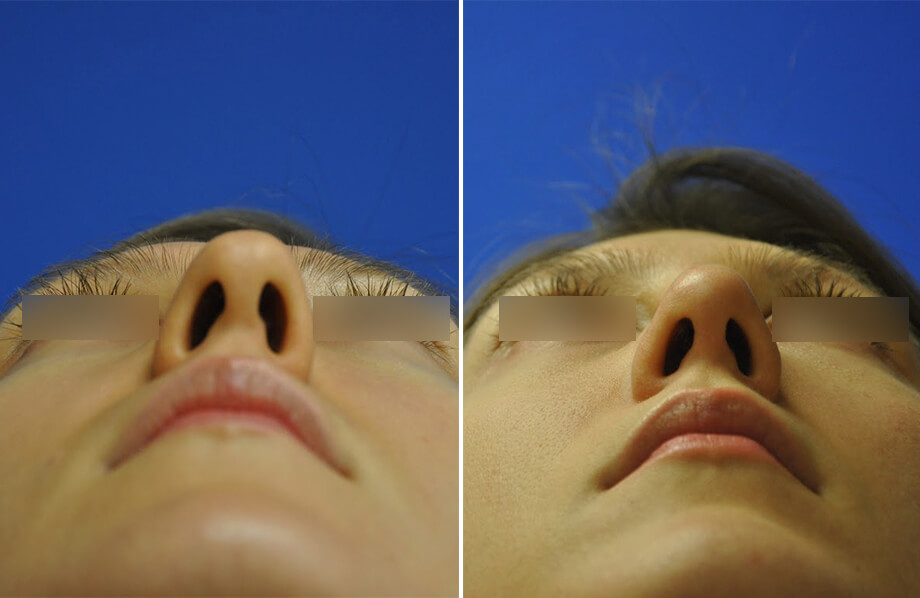 Rhinoplasty Before and After Patient 4