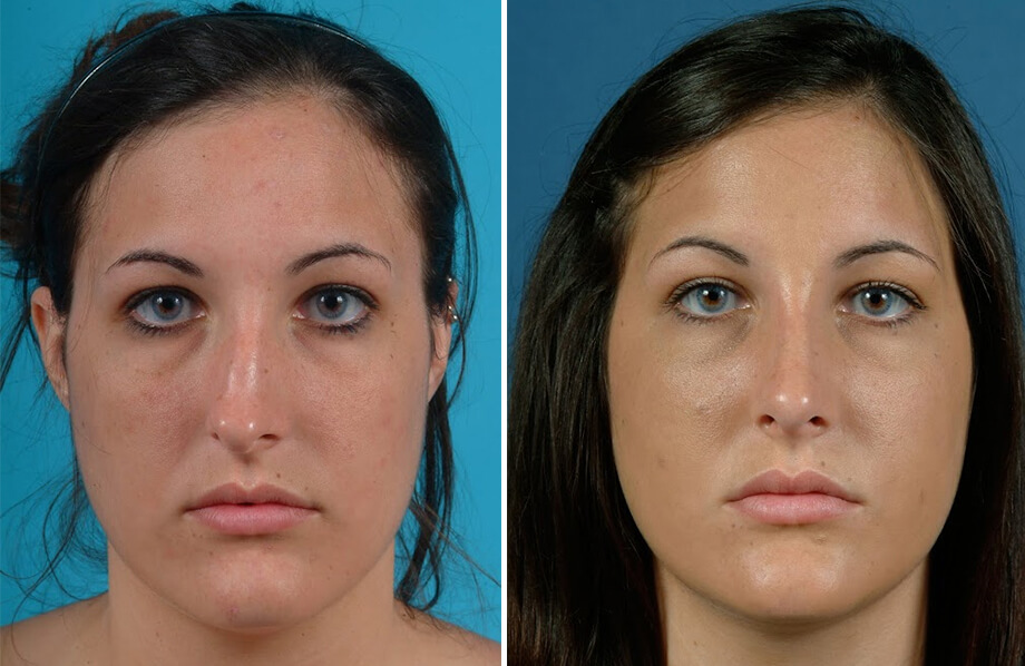 Rhinoplasty Before and After Patient 2