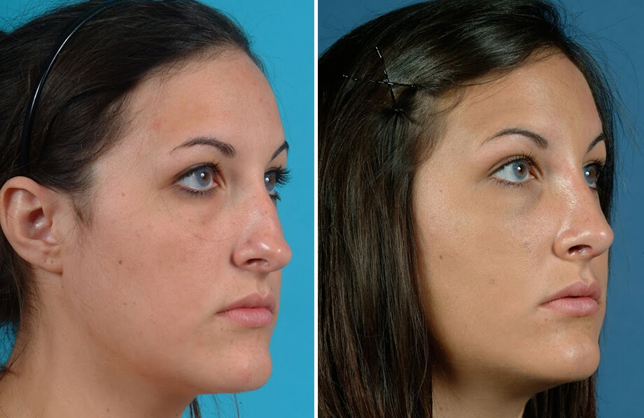 Rhinoplasty Before and After Patient 3