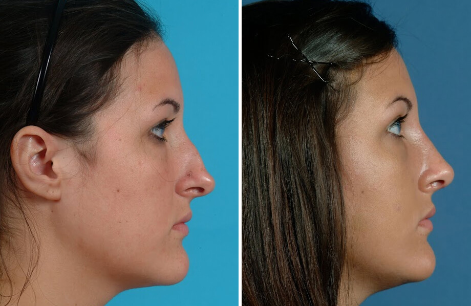 Rhinoplasty Before and After Patient 1
