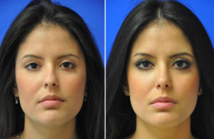 Rhinoplasty Before and After Patient Thumbnail 2