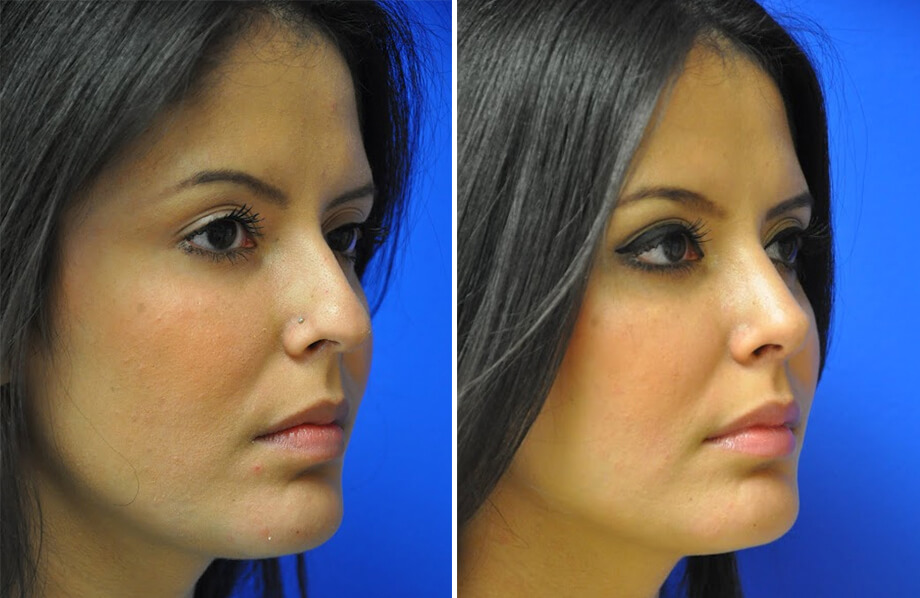 Rhinoplasty Before and After Patient 3