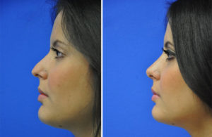 Rhinoplasty Before and After Patient Thumbnail 1