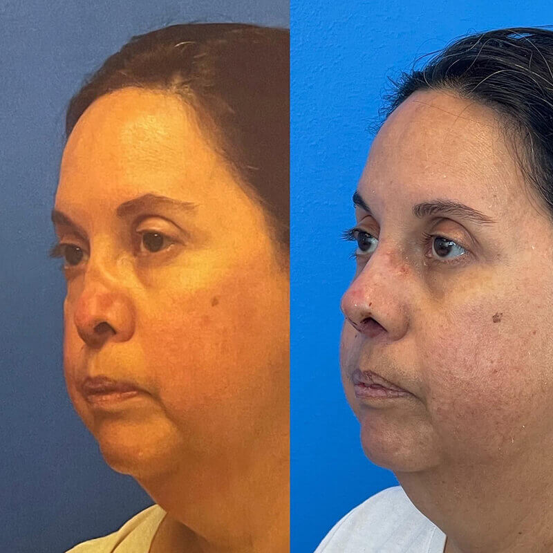 Rhinoplasty Before and After Patient 2