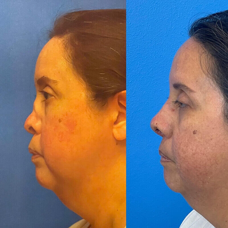 Rhinoplasty Before and After Patient 3