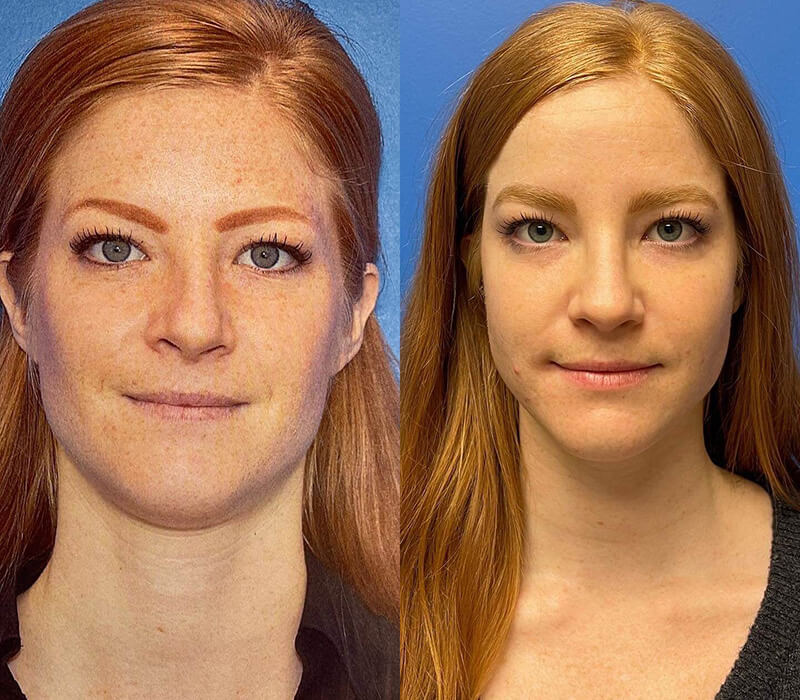 Rhinoplasty Before and After Patient 1