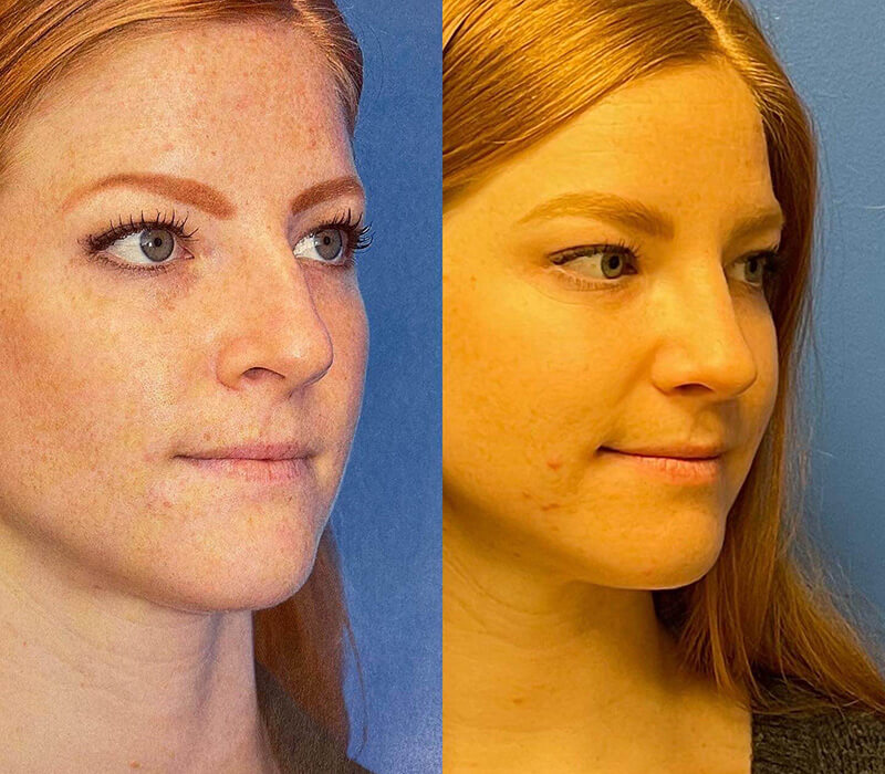 Rhinoplasty Before and After Patient 2