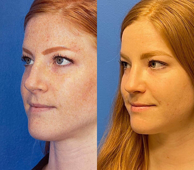 Rhinoplasty Before and After Patient 4