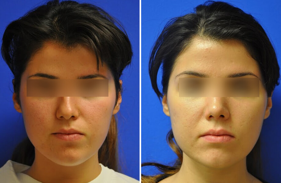 Rhinoplasty Before and After Patient 2