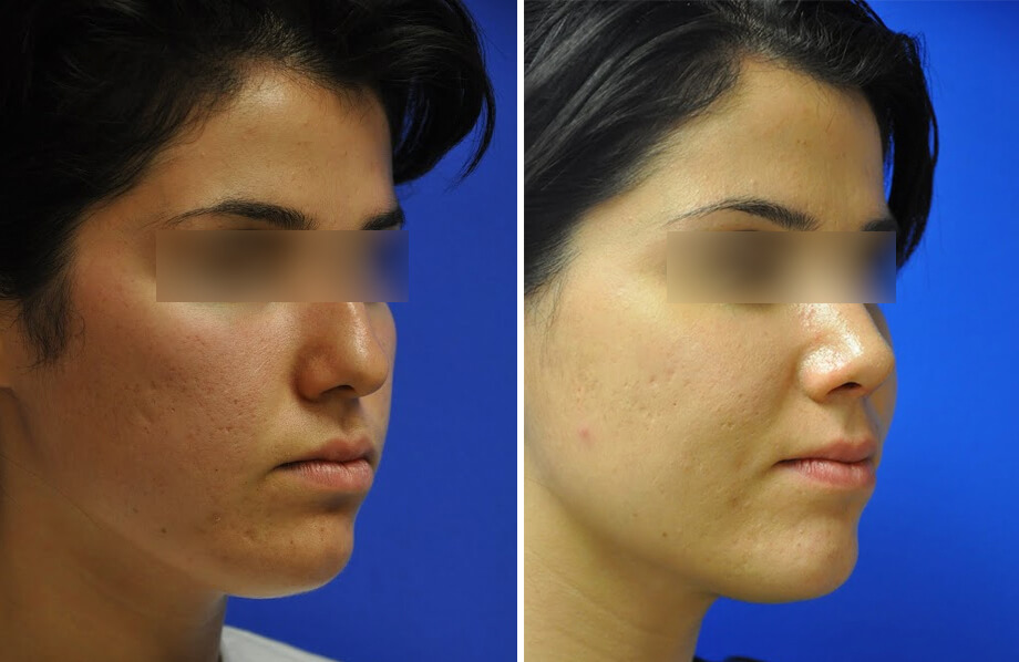 Rhinoplasty Before and After Patient 3