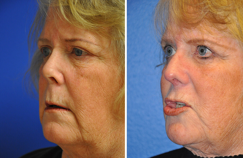 Face Before and After Patient 3