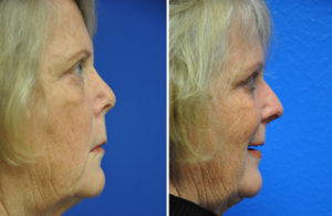 Face Before and After Patient Thumbnail 4