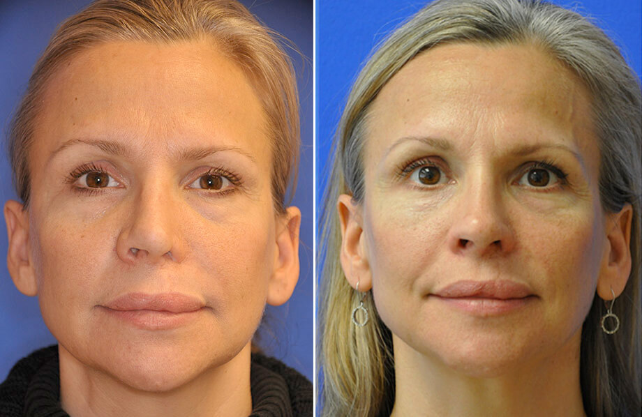 Face Before and After Patient 3
