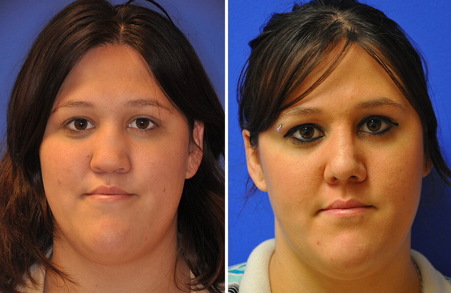 Face Before and After Patient 2