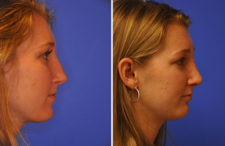 Face Before and After Patient 2