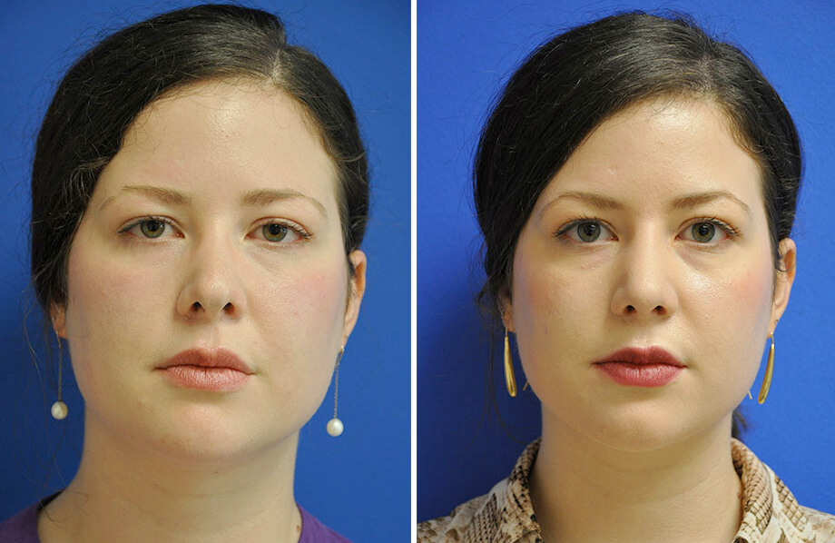 Face Before and After Patient 3
