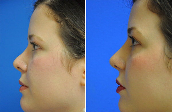 Face Before and After Patient 1