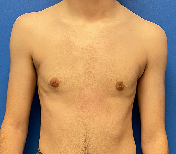 Top Surgery: FTM, Non Binary, Gender Nonconforming Before and After Patient 1