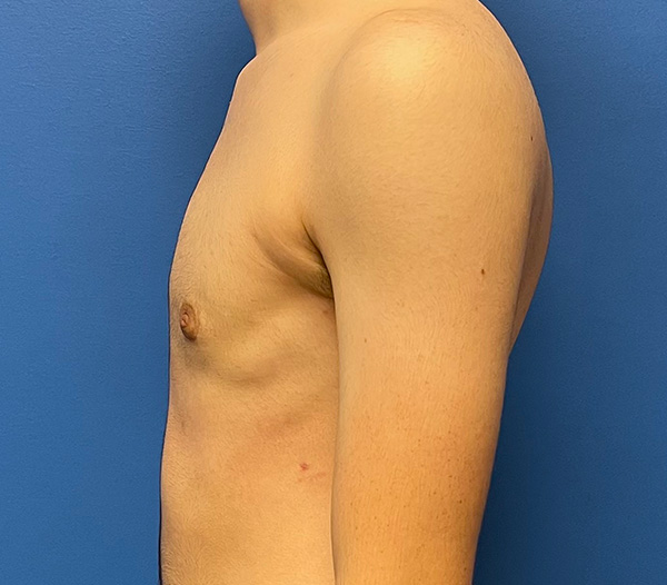 Top Surgery: FTM, Non Binary, Gender Nonconforming Before and After Patient 2